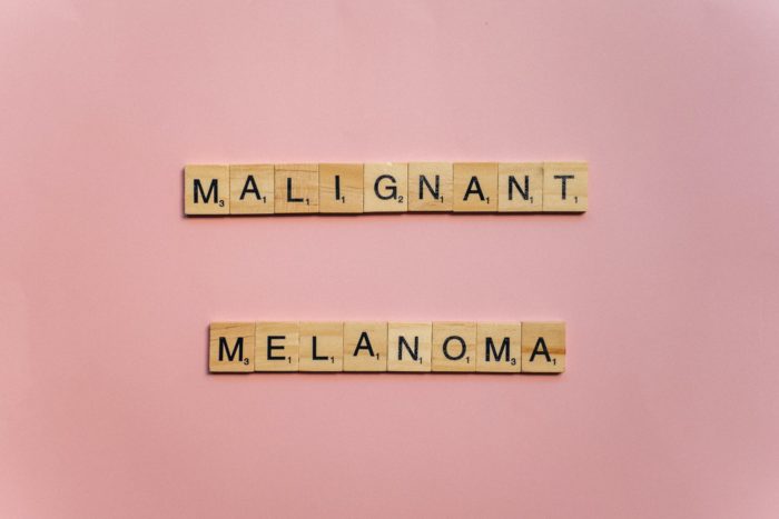 melanoma 700x467 - Awas! Resiko Kanker Melanoma Sering Mengincar Kita